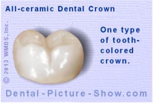 all-ceramic-crown