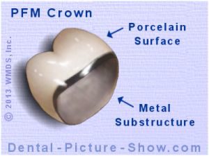 porcelain-fused-metal-crown