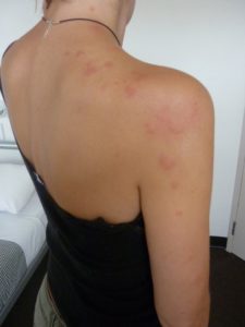 bedbug skin rash ベッドバグ　肌　症状　噛まれた跡