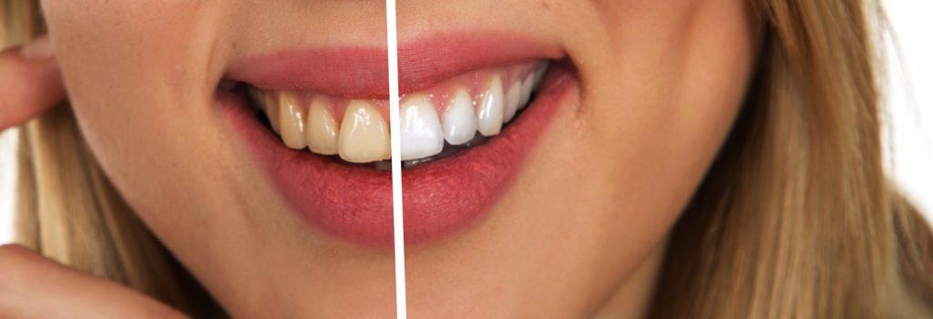 teeth whitening　歯　ホワイトニング　アメリカ　クレスト