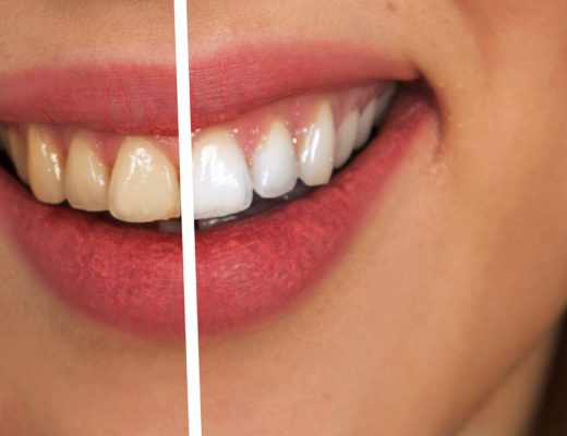 teeth whitening　歯　ホワイトニング　アメリカ　クレスト